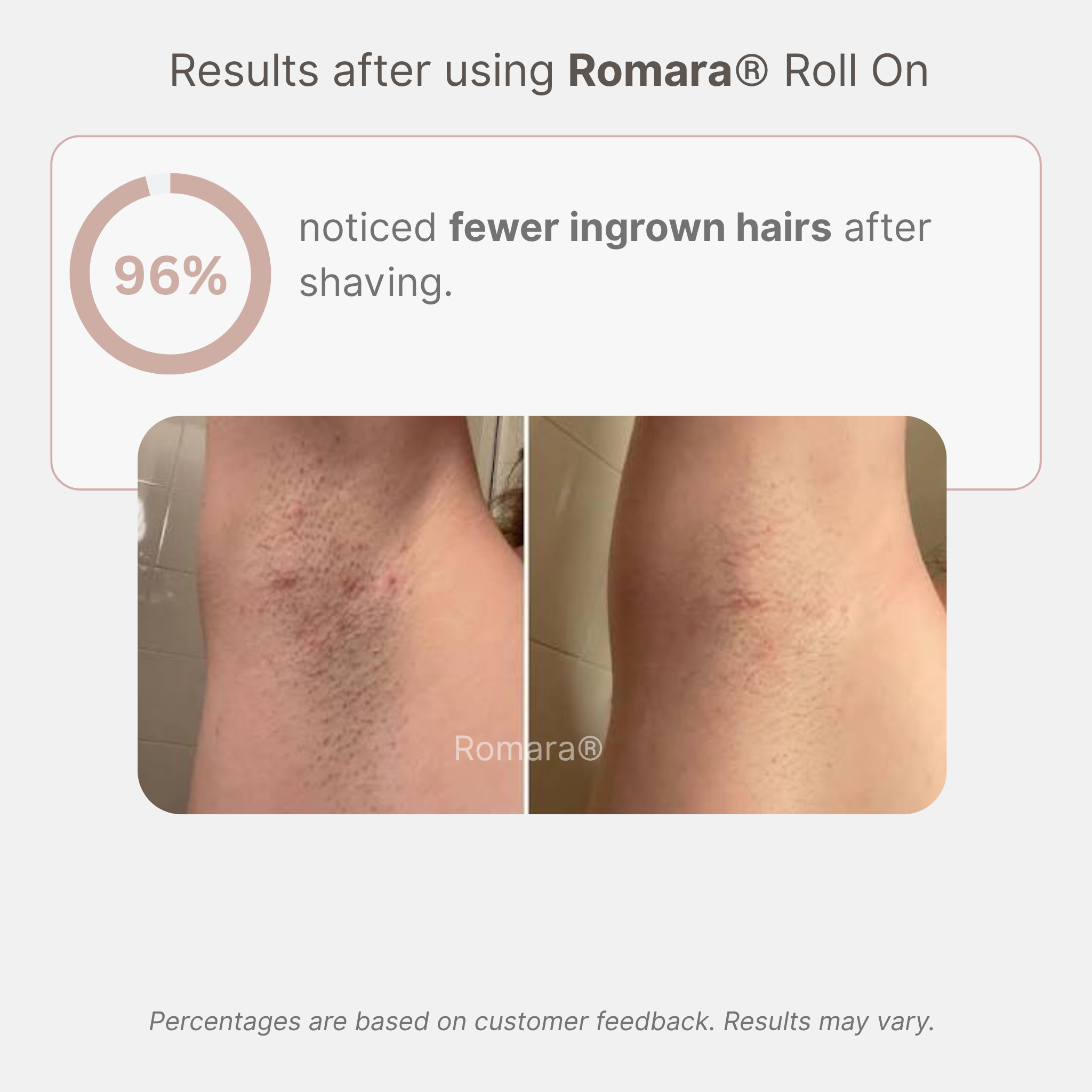 Romara® Roll-on for ingrown hairs and bumps