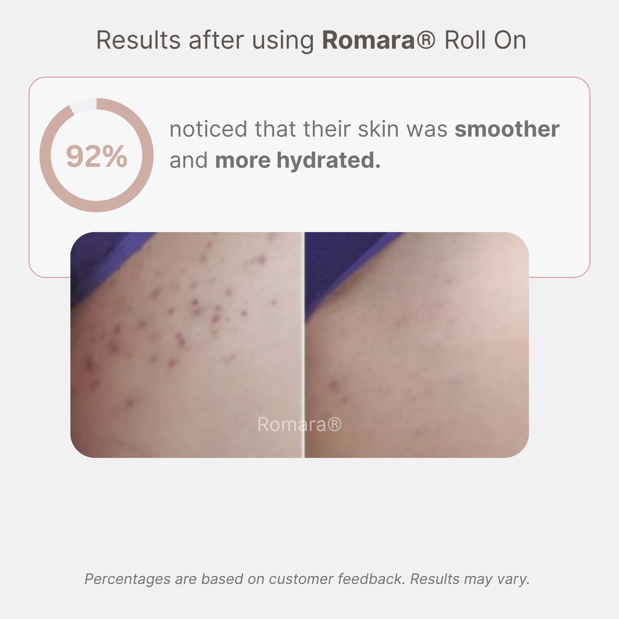 Romara® Roll-on for ingrown hairs and bumps