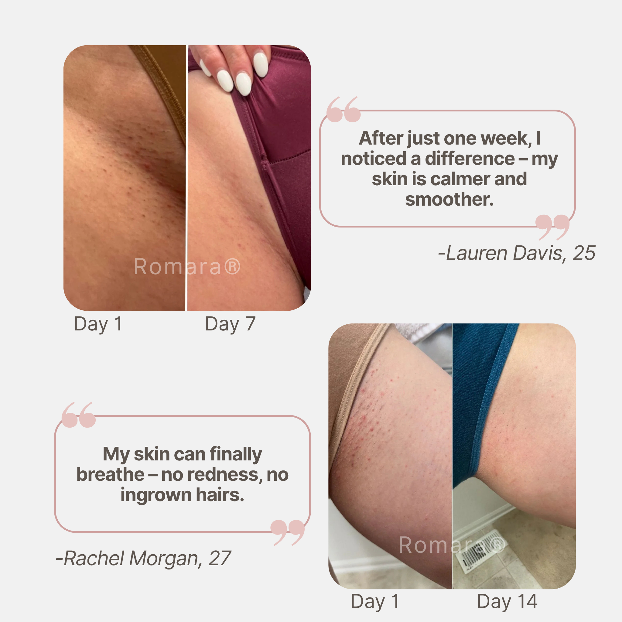 Romara® Roll-on for ingrown hairs and bumps