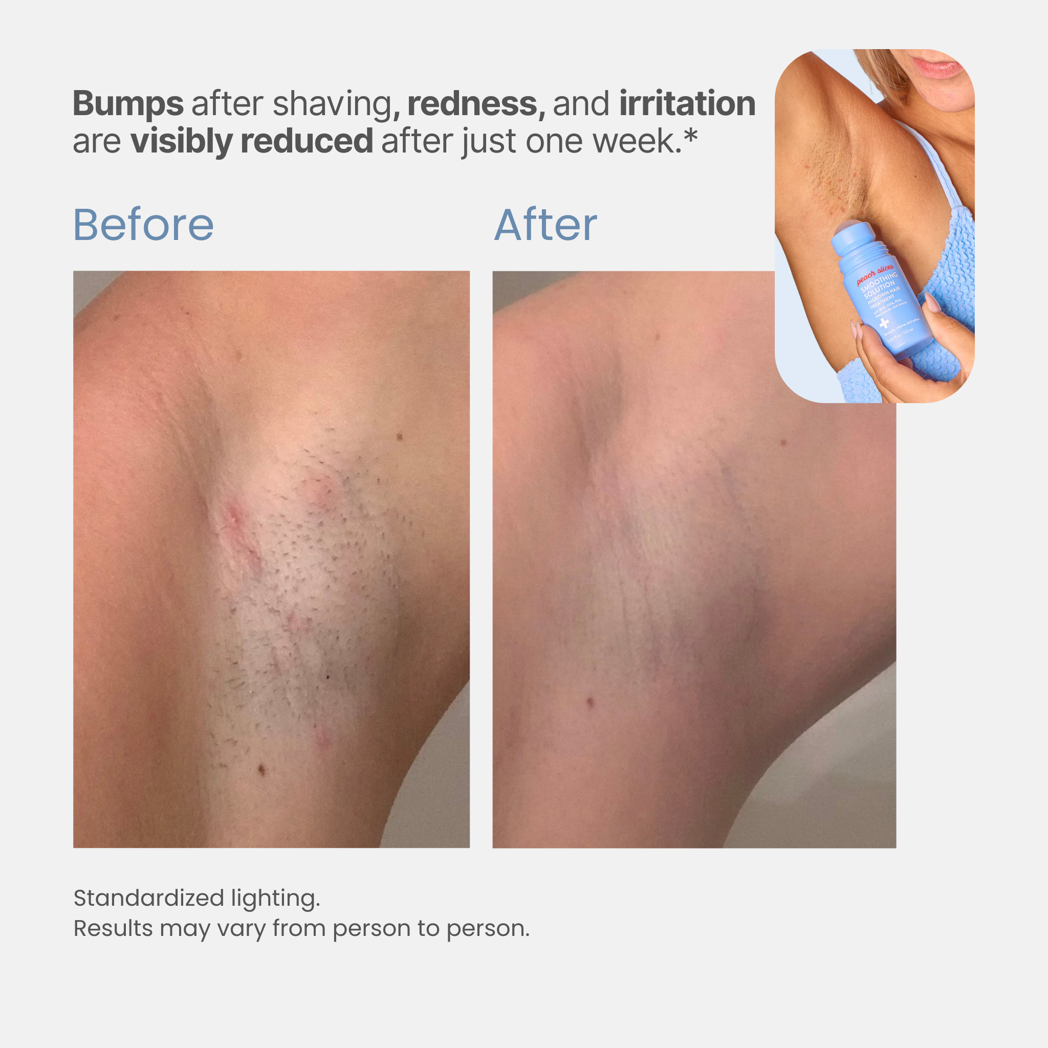 Romara® Roll-on for ingrown hairs and bumps