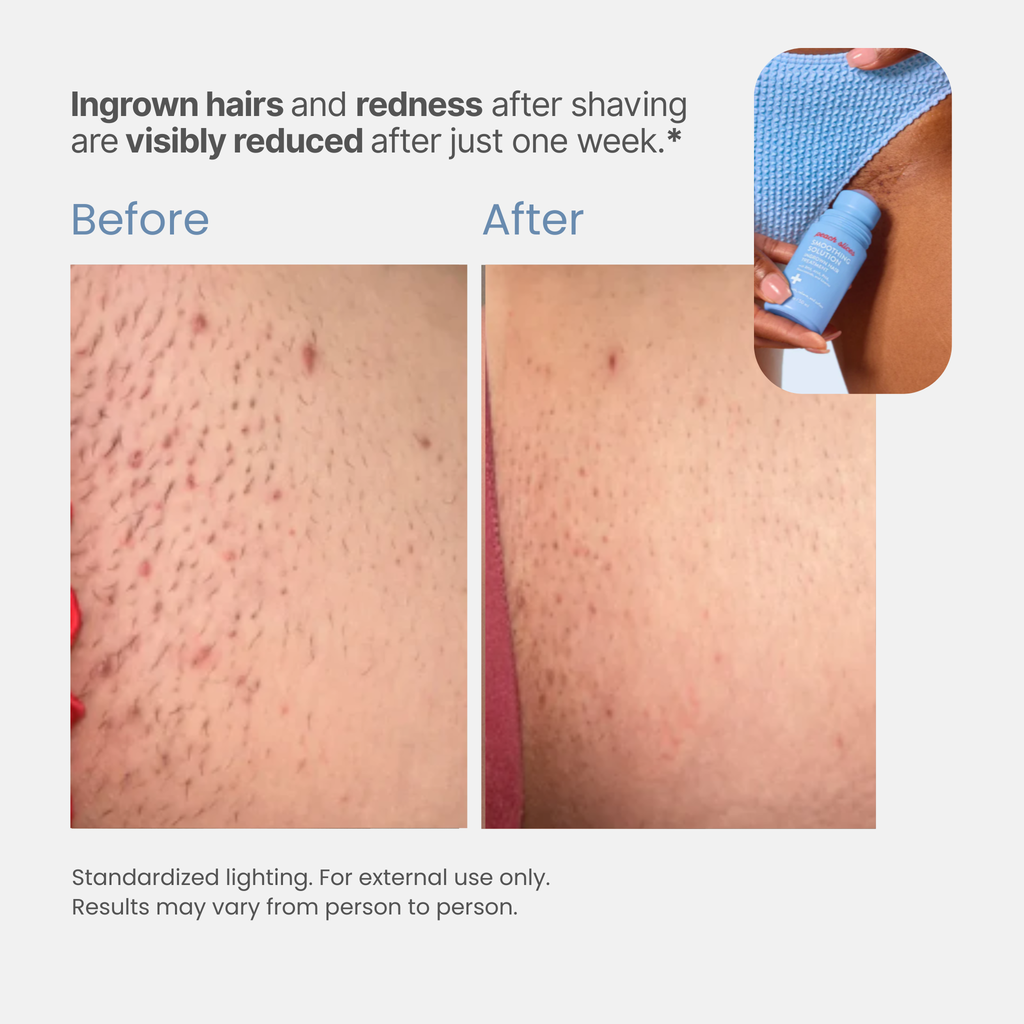 Romara® Roll-on for ingrown hairs and bumps