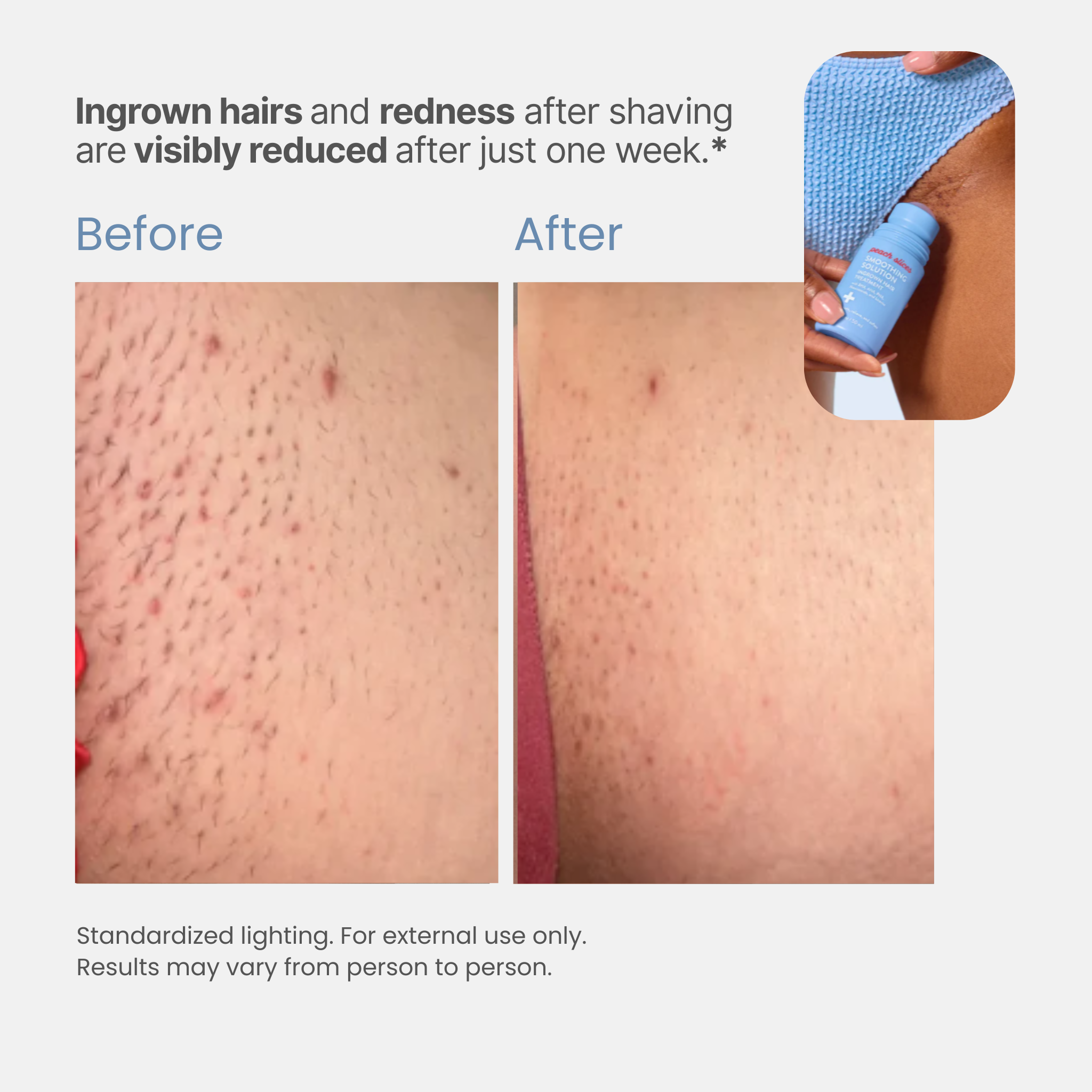 Romara® Roll-on for ingrown hairs and bumps